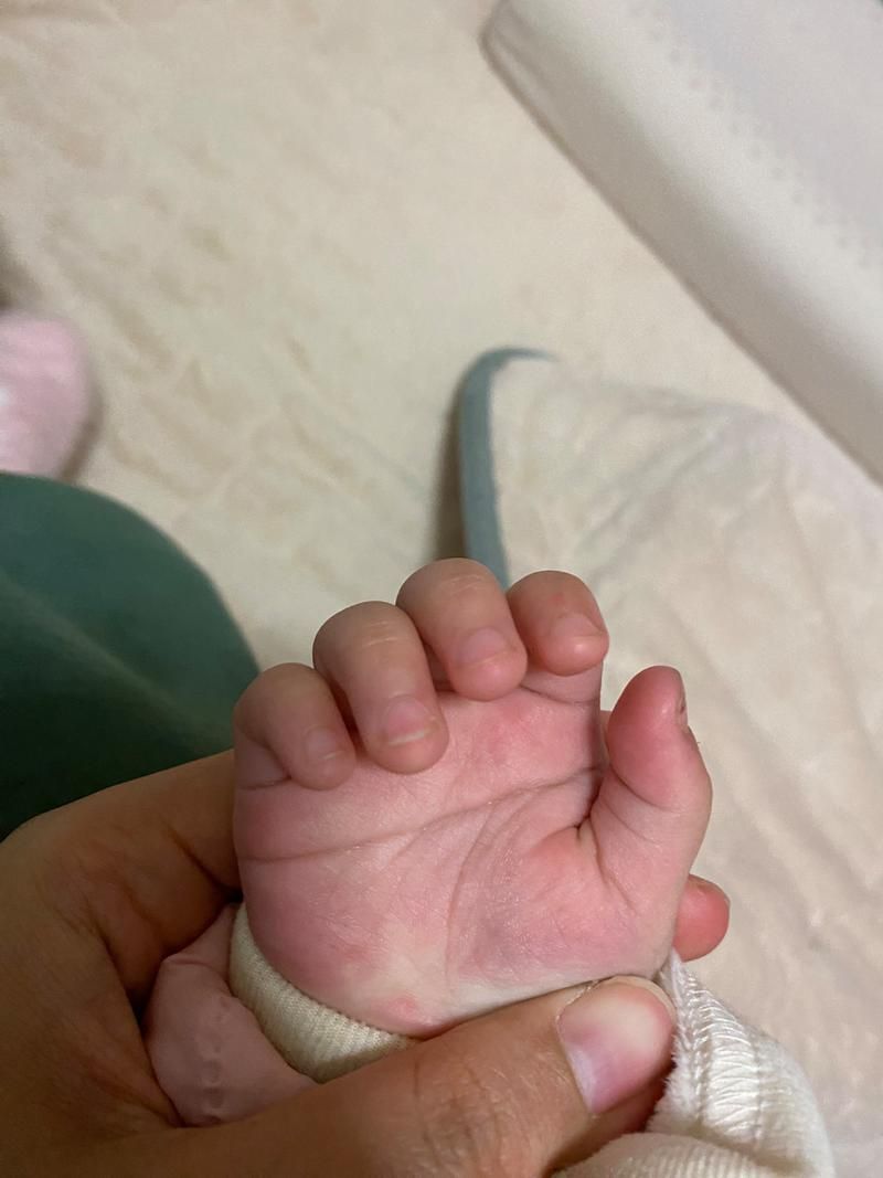 孩子断掌有什么影响，钆喷酸葡胺和钆贝葡胺的区别