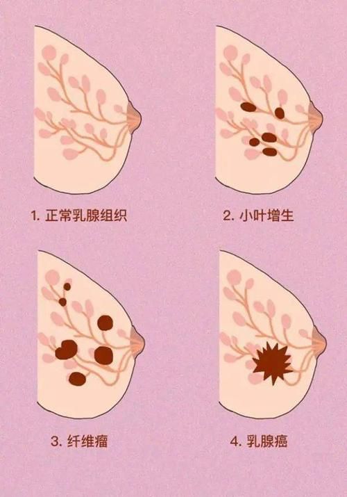 50岁以后乳腺增生还会疼吗，56微播江湖官网