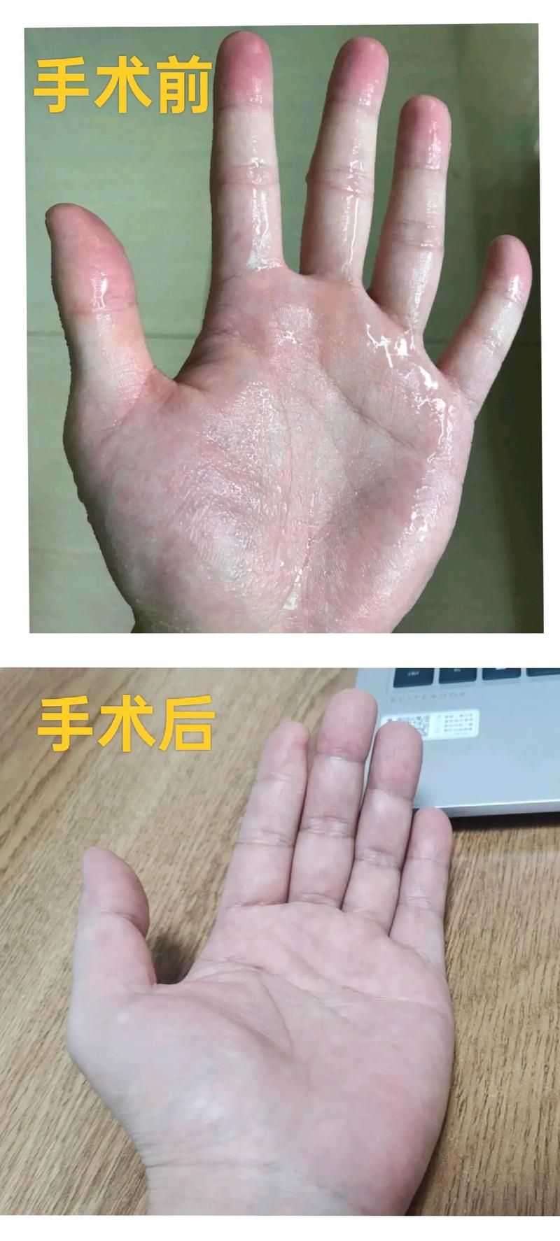 玩游戏手心出汗是病吗？如何缓解手汗困扰！