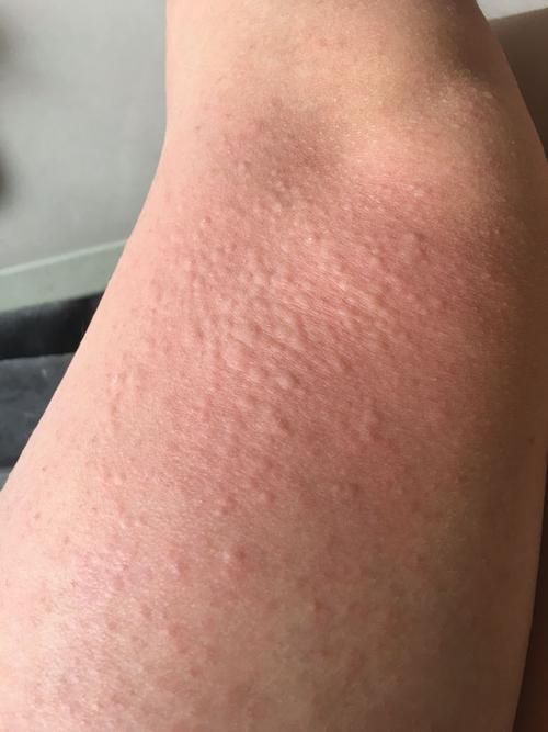 tuimofen效果怎么样 退烧药真实使用体验分享