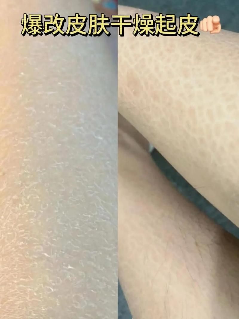 为什么有时候皮肤干燥脱皮还容易过敏