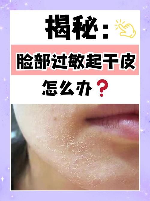 为什么有时候皮肤干燥脱皮还容易过敏