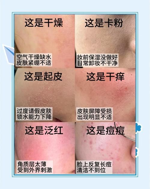 为什么有时候皮肤干燥脱皮还容易过敏