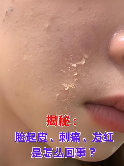 为什么有时候皮肤干燥脱皮还容易过敏