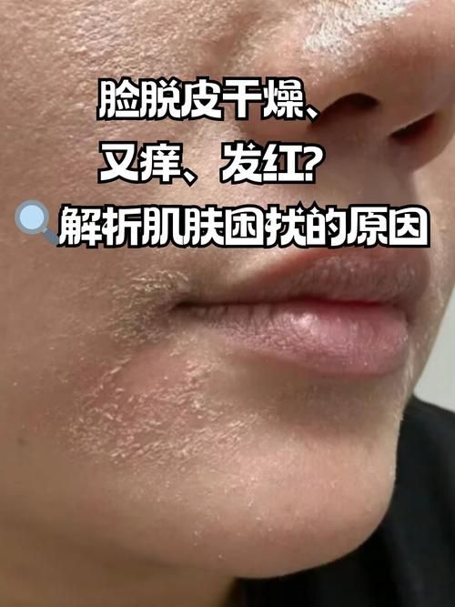 为什么有时候皮肤干燥脱皮还容易过敏