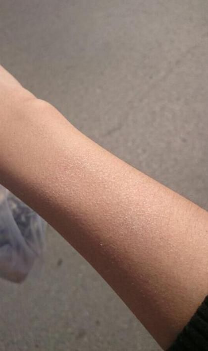 为什么有时候皮肤干燥脱皮还容易过敏