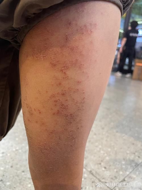 为什么有时候皮肤干燥脱皮还容易过敏