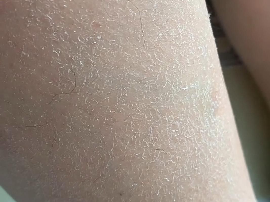 为什么有时候皮肤干燥脱皮还容易过敏