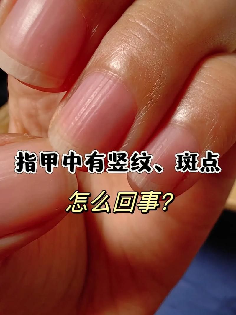 指甲竖纹蚂蚁庄园解析指甲竖纹的原因
