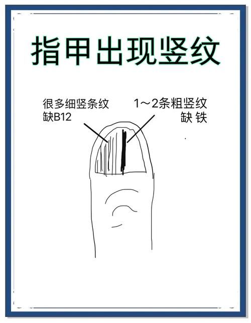 指甲竖纹蚂蚁庄园解析指甲竖纹的原因
