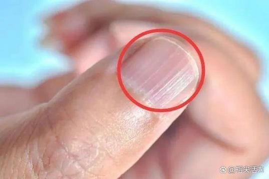 指甲竖纹蚂蚁庄园解析指甲竖纹的原因