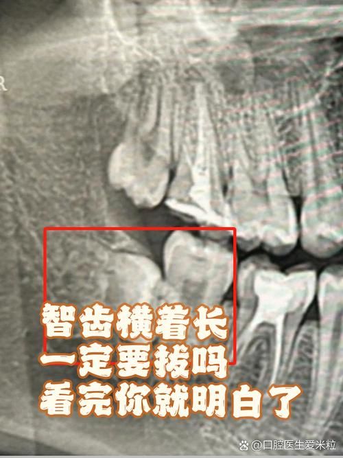 智齿人人都会长吗 不长智齿正常吗
