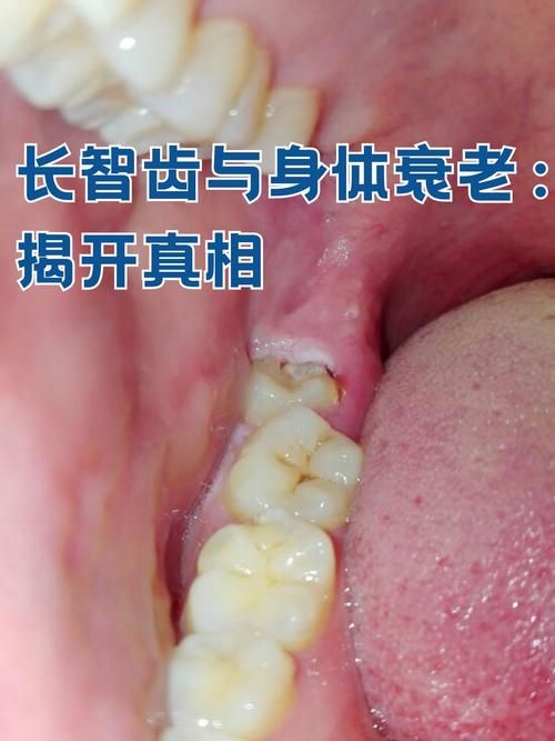 智齿人人都会长吗 不长智齿正常吗