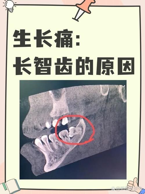 智齿人人都会长吗 不长智齿正常吗