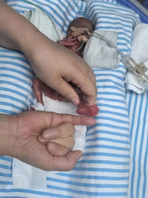 最小存活婴儿出院记 专家揭秘早产儿救治全过程
