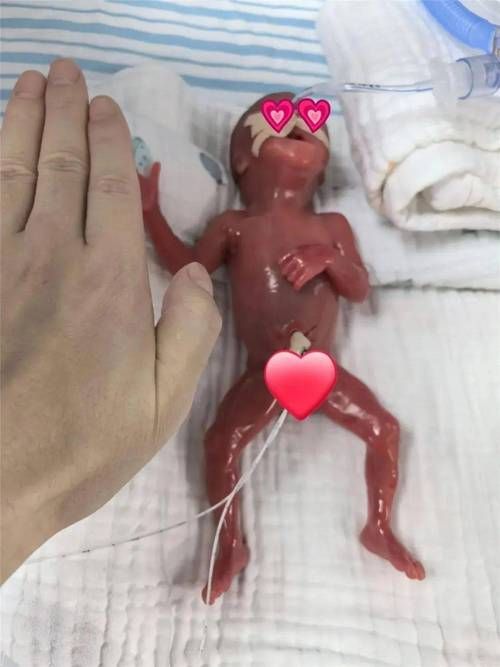 最小存活婴儿出院记 专家揭秘早产儿救治全过程